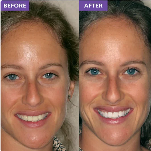 DR.PEARL™ Whitening Strips